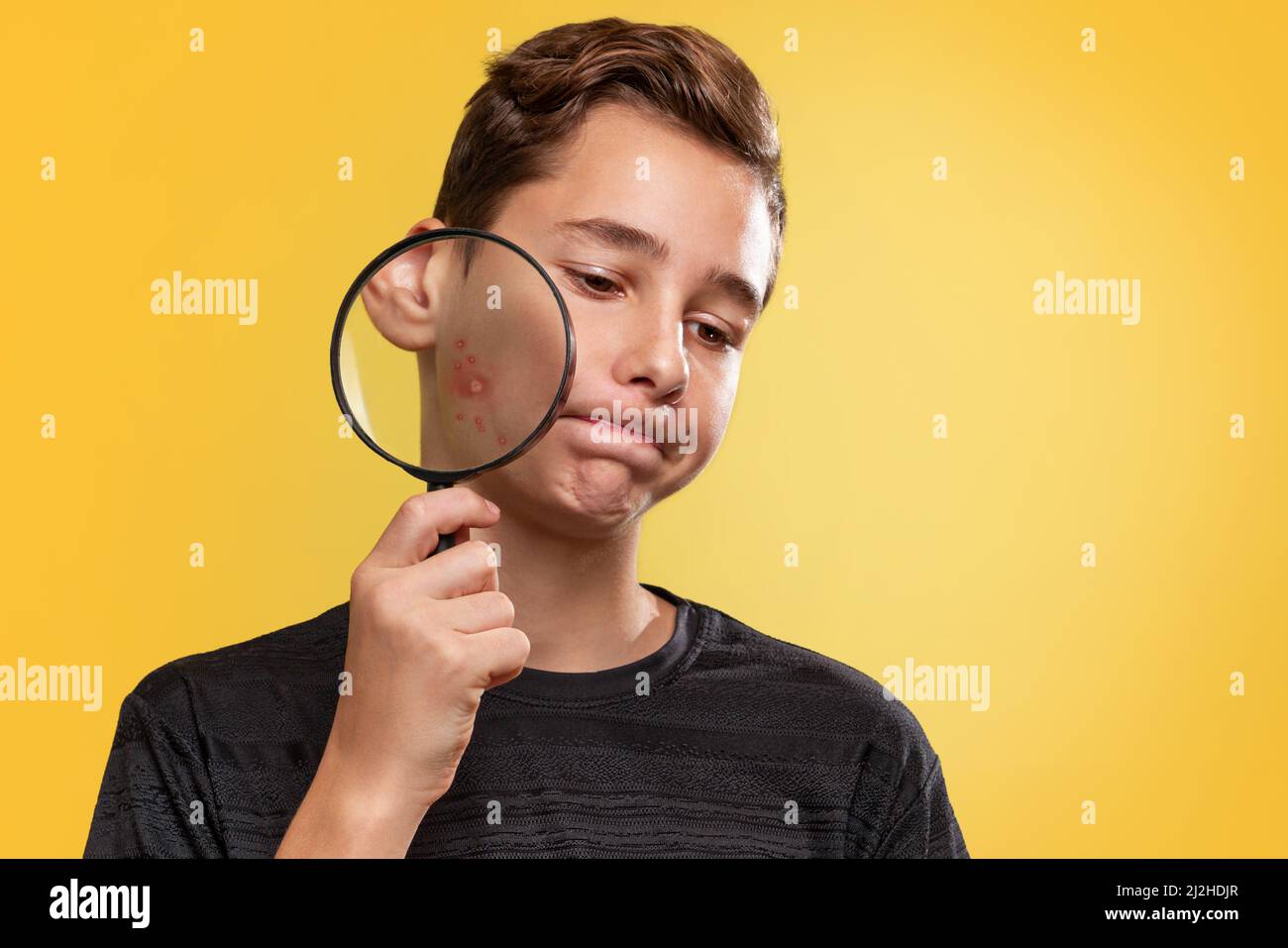 Das Konzept der Teenager-Akne. Ein Teenager mit einem verärgerten Gesicht, der eine Lupe mit Pickel in der Nähe der Wange hält. Gelber Hintergrund. Kopie sp Stockfoto