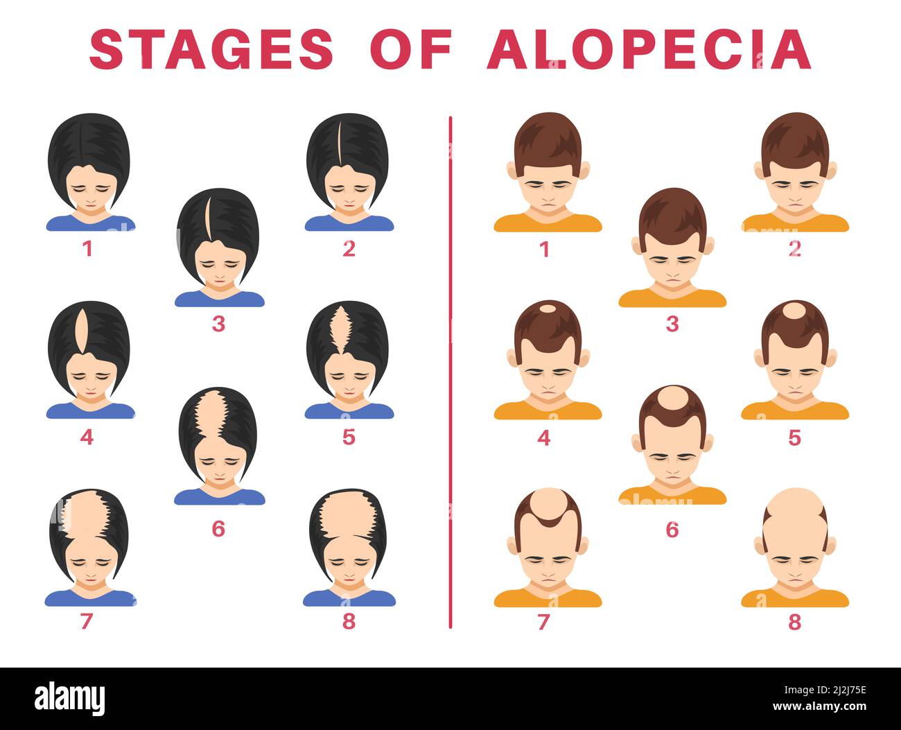 Phasen der Alopezie bei Männern und Frauen Vektor-Illustrationen-Set. Spitzen männlicher und weiblicher Köpfe mit kahlen Flecken auf schuppigen Stellen, isoliert auf weißem Hintergrund. Er Stock Vektor