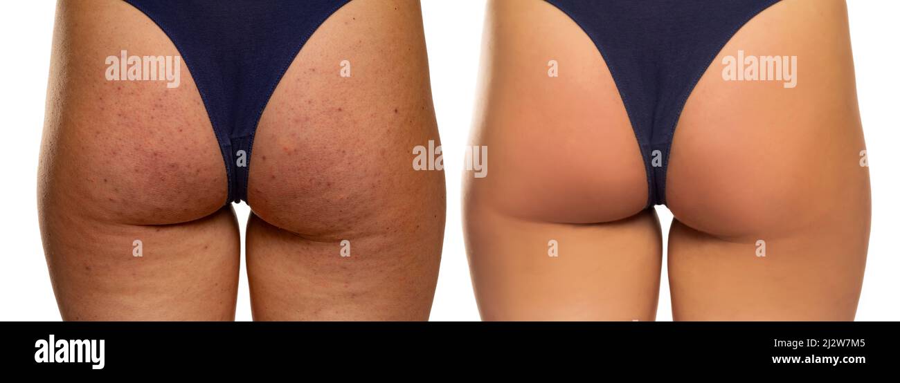Weibliches Gesäß vor und nach der Behandlung auf weißem Hintergrund Stockfoto