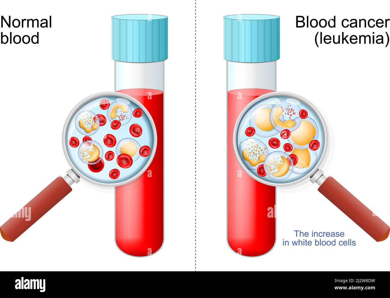 Leukämie. Rote und weiße Blutkörperchen in Reagenzglas in Lupe. Vergleich und Unterschied zwischen gesundem Blut und Blutkrebs Stock Vektor