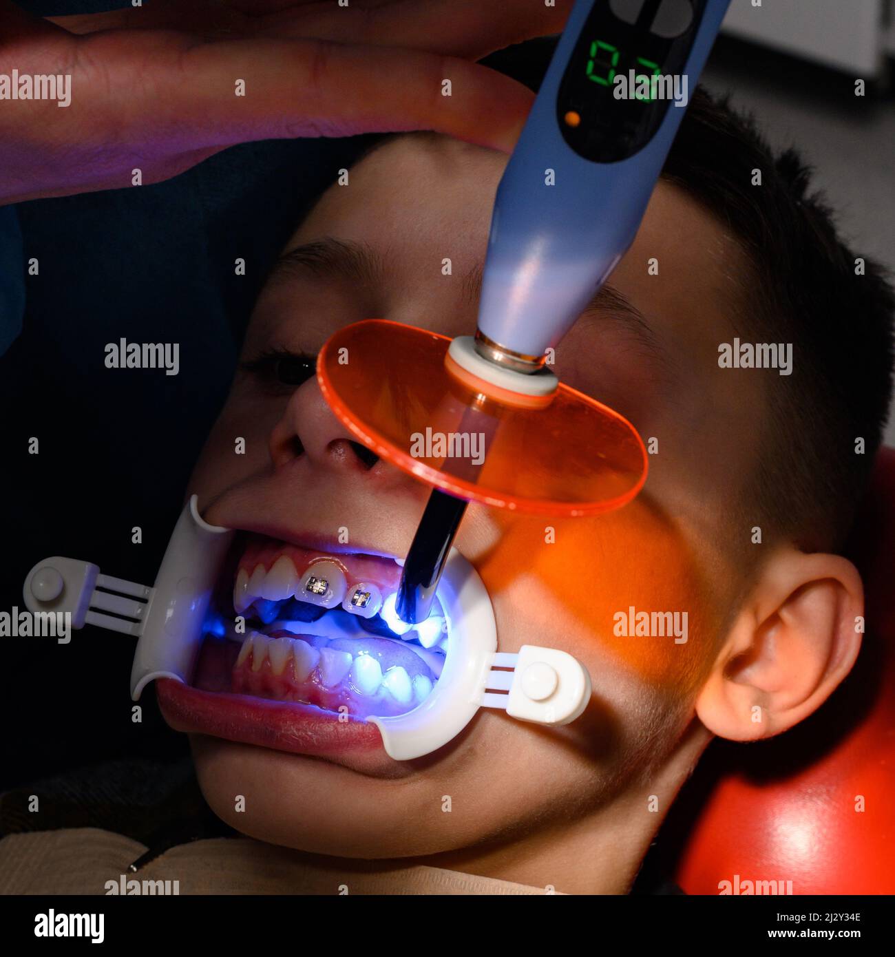 Ausrichtung von schiefen Zähnen mit Hilfe von Zahnspangen, Installation ...