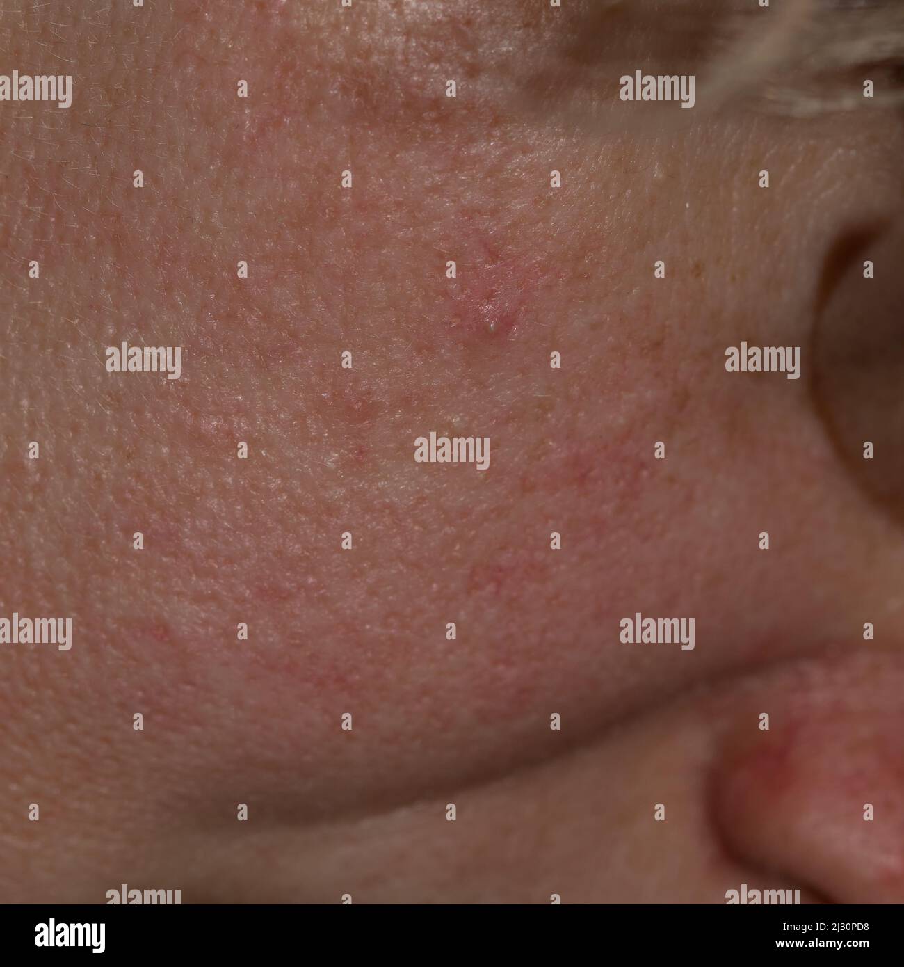 Makrofoto der Gesichtshaut mit milder Rötung und kleinen Reizflecken. Die Nahaufnahme hebt natürliche Textur, Poren und Farbvariationen hervor Stockfoto