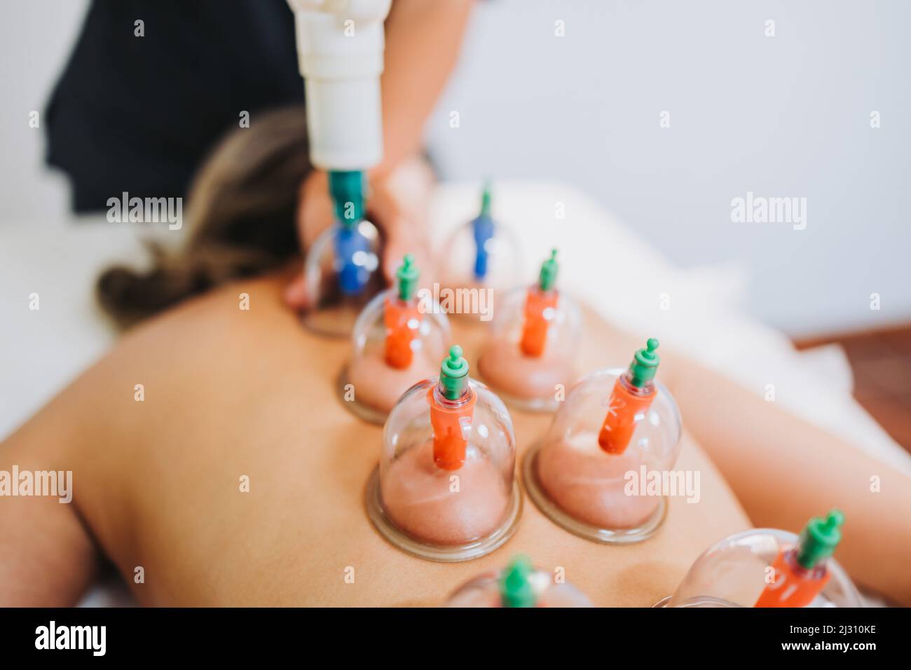 Saugnäpfe, die von einem Masseur auf den Rücken einer Patientin gelegt werden. Medizinisches Spa-Massagezentrum. Stockfoto