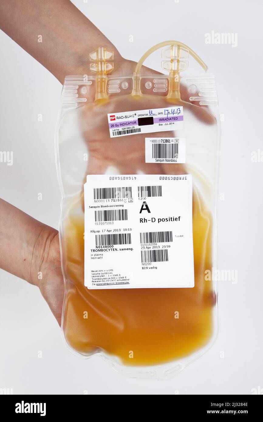 Ein Beutel für die Infusion mit Extrakt aus Thrombozyten, auch Thrombozyten genannt. Stockfoto