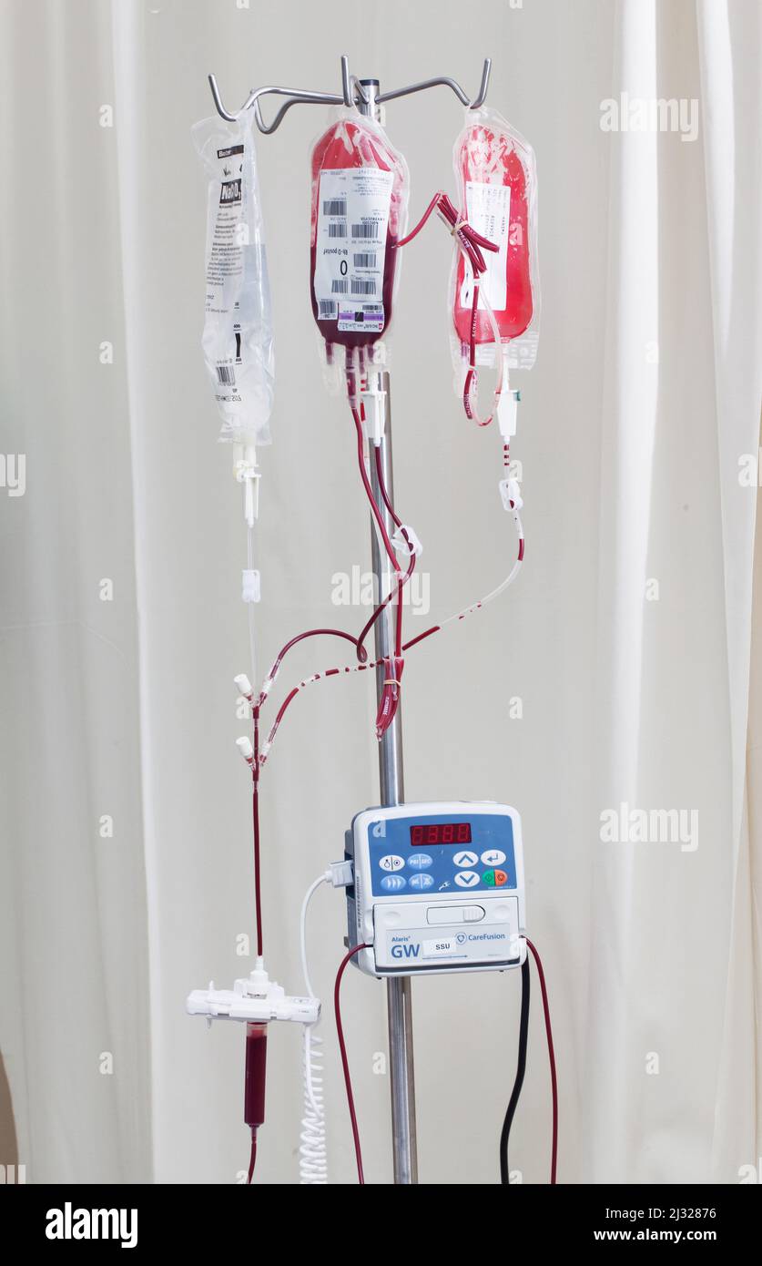 Infusion mit Extrakt aus roten Blutkörperchen oder Erythrozyten. (RBC) Stockfoto
