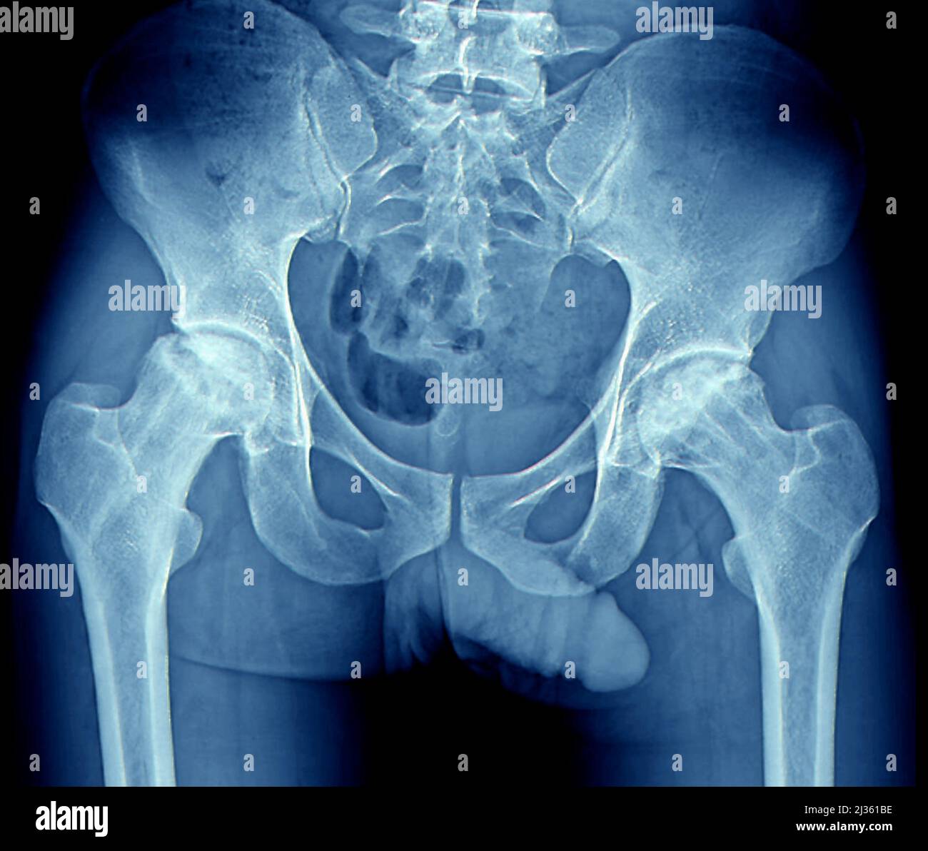 Schmerzhafte Hüften, Röntgen Stockfoto