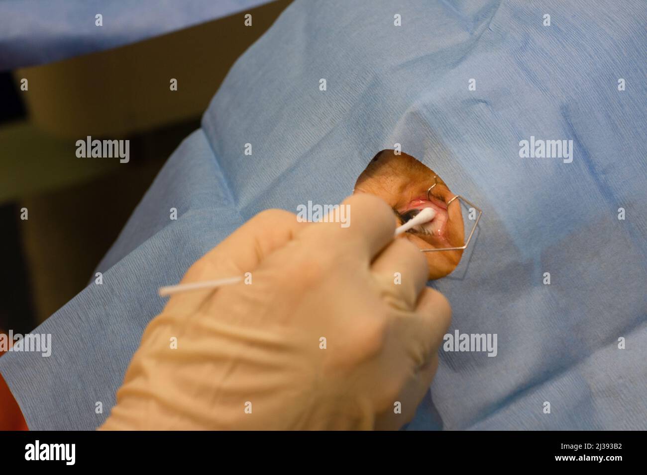 Nahaufnahme eines menschlichen Auges in einem ophthalmologischen Operationssaal. Pressung mit einem Isopod nach einer intravitrealen Injektion. Stockfoto