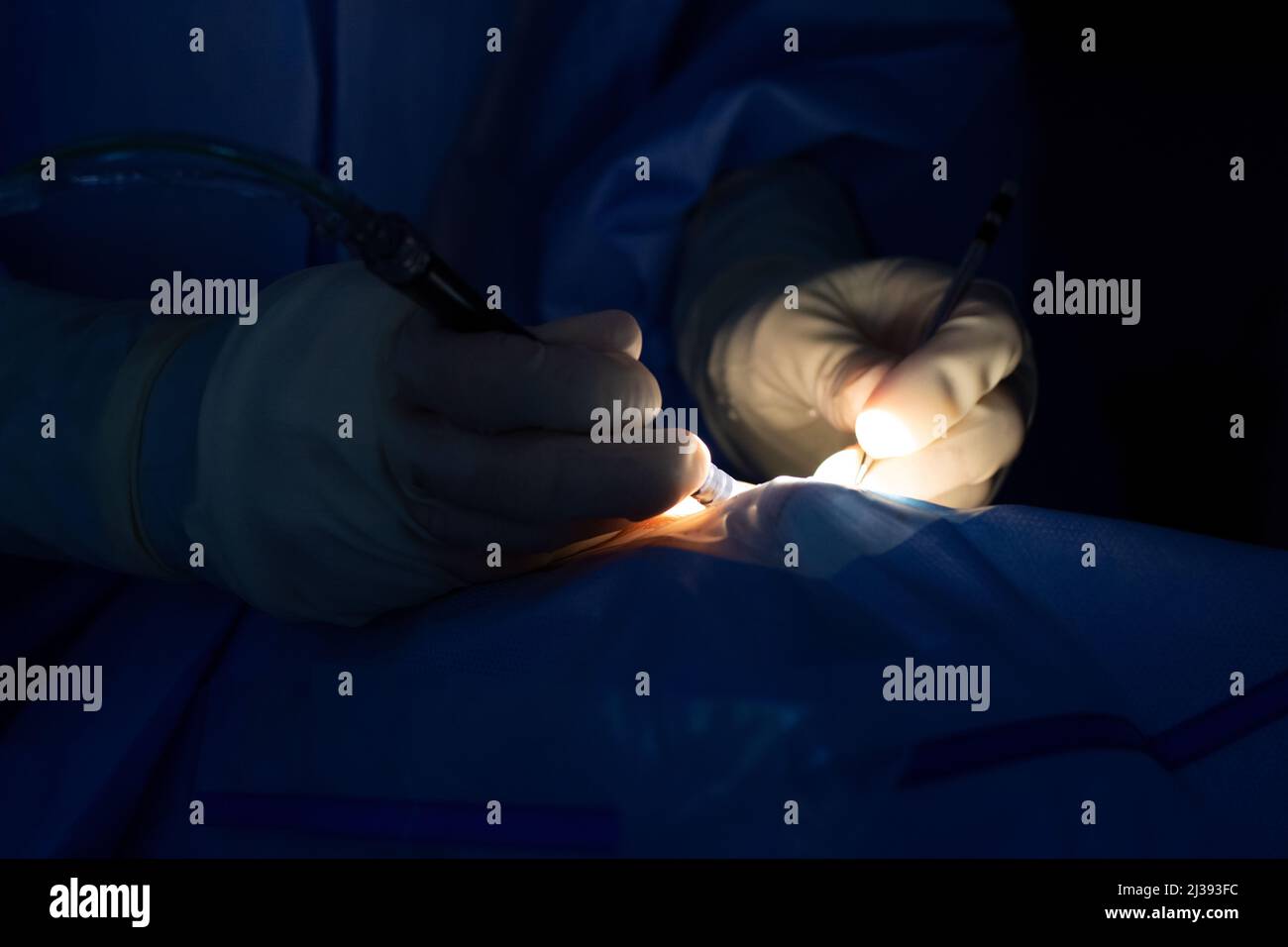 Nahaufnahme der Hände des Augenarztes, die an einem Katarakt operieren, mit einer Bewässerungs- und Aspirationssonde und einem Hilfsstab. Sterile Handschuhe und blaue OP-Handschuhe Stockfoto