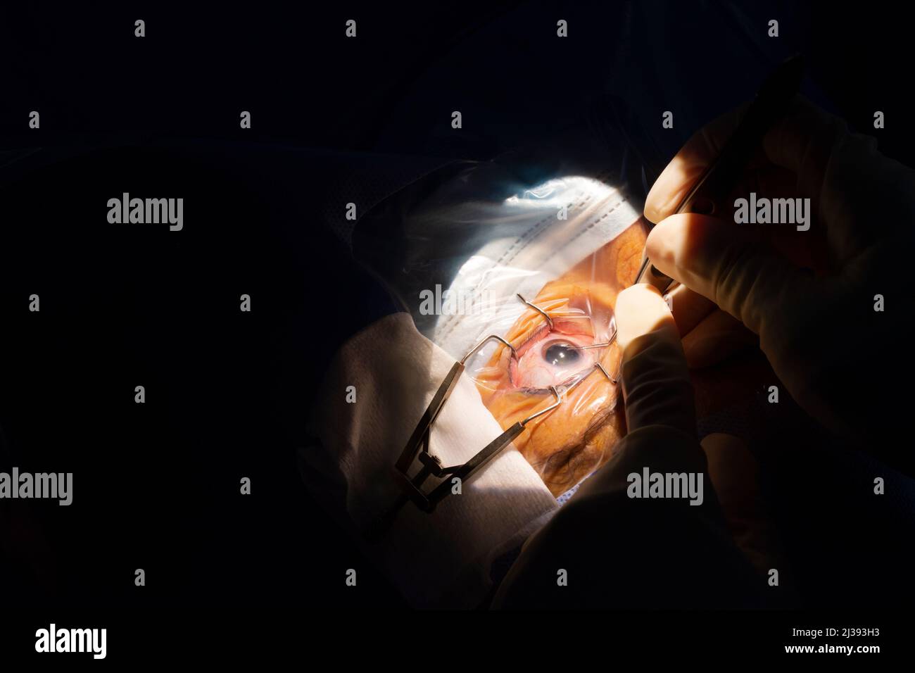 Nahaufnahme eines menschlichen Auges, Kataraktoperation in einem ophthalmologischen Operationssaal. Sterile Drapierung und Hände des Chirurgen mit sterilen Handschuhen, die eine Katara einführen Stockfoto