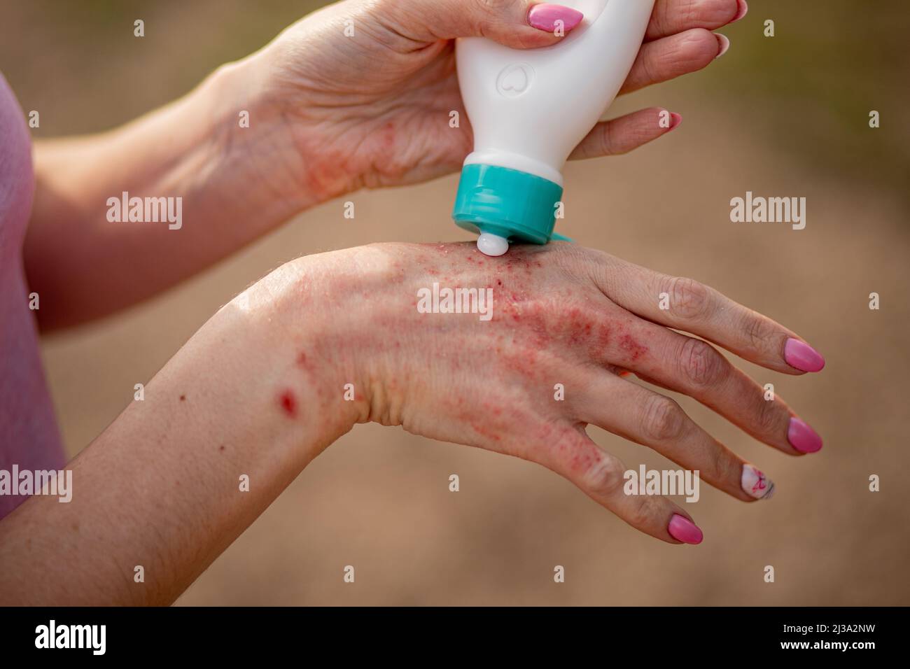 Ekzem an den Händen. Die Frau Anwendung der Salbe , Cremes bei der Behandlung von Ekzemen, Psoriasis und anderen Hautkrankheiten. Konzept für Hautprobleme. Stockfoto