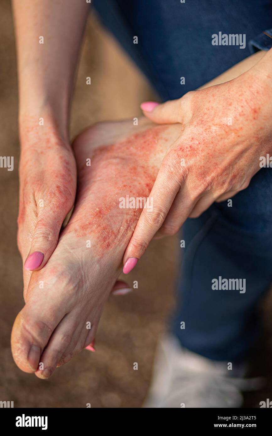 Ekzemdermatitis an Händen und Füßen. Rote Flecken auf der Haut. Trockene Haut. Stockfoto