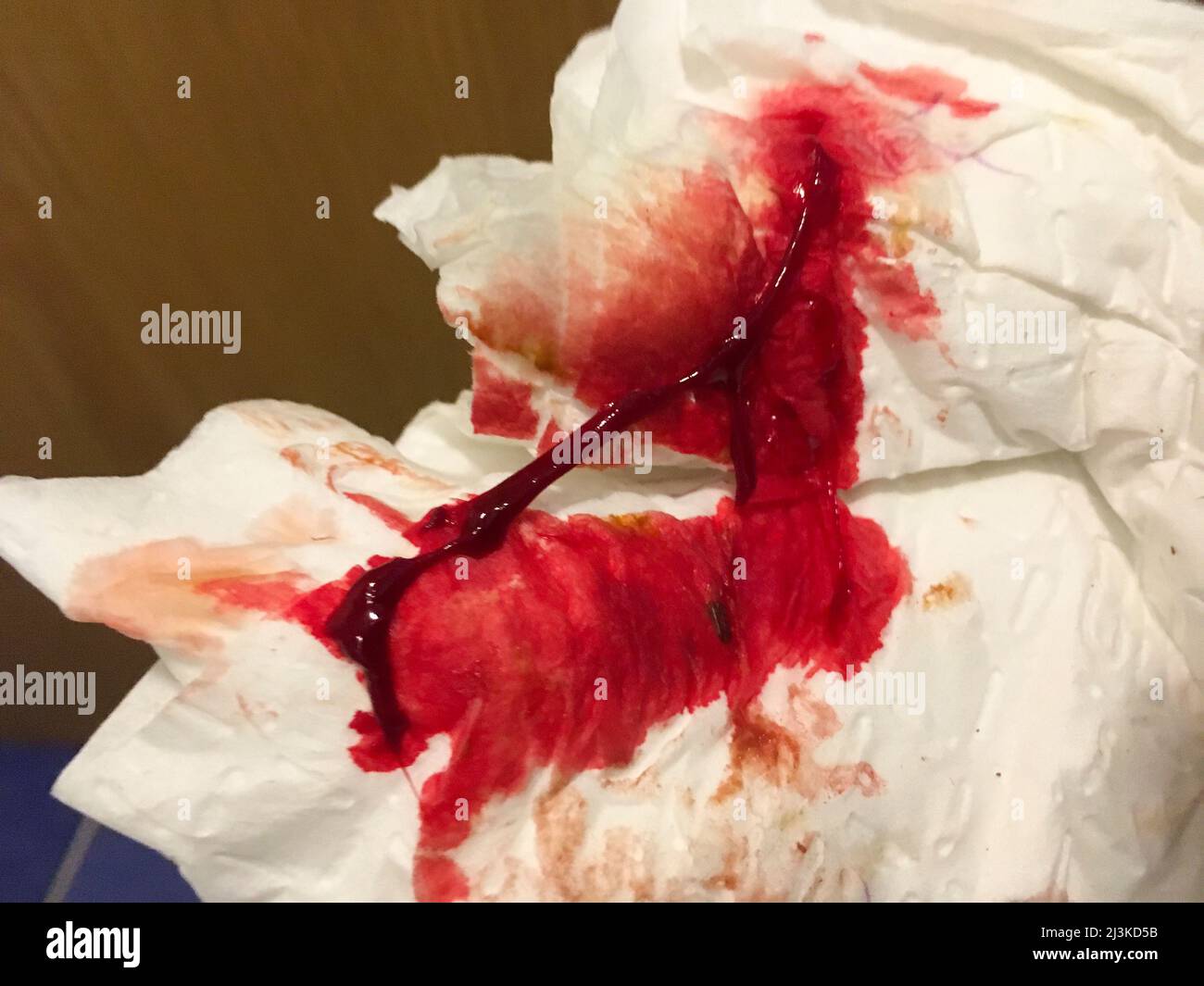 Hämorrhoiden Blut und Schleim auf dem Toilettenpapier Stockfotografie -  Alamy