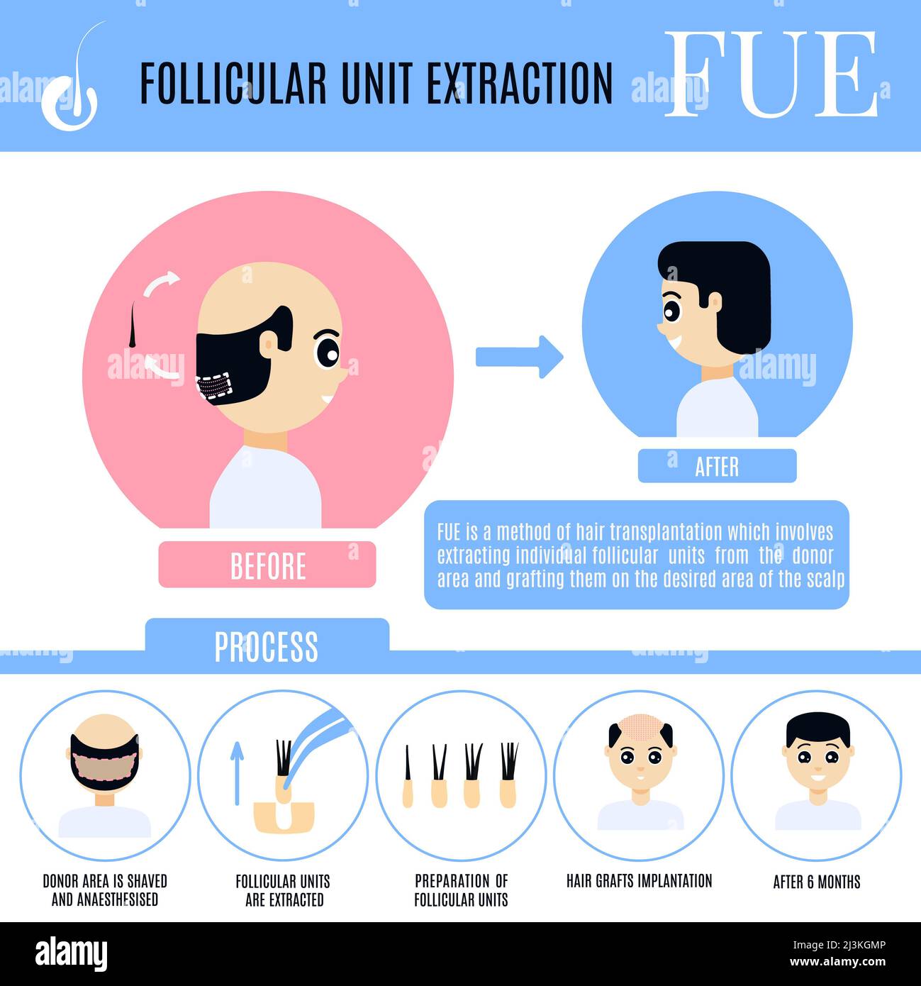 FuE-Haartransplantation bei Männern, Illustration Stockfoto