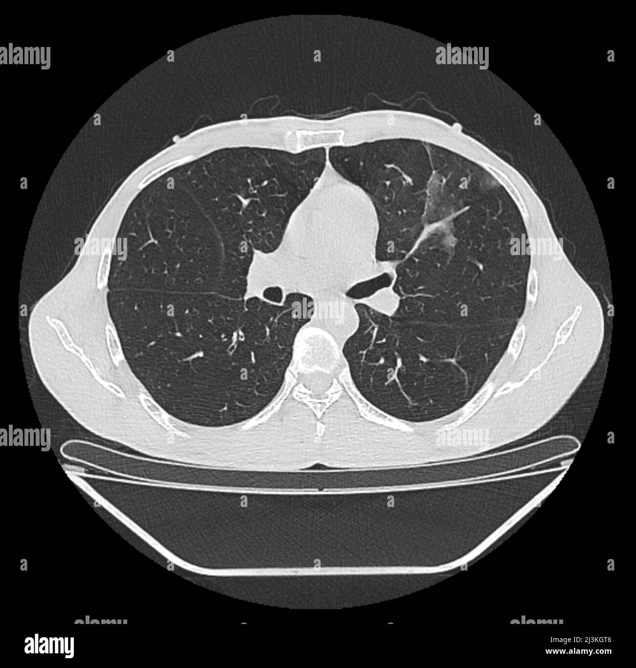 Covid-19 Pneumonie, Thorax-CT-Scan Stockfoto