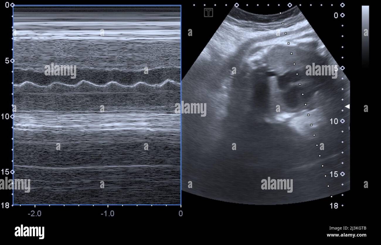 Herzschlag des Babys, Ultraschalluntersuchung Stockfoto