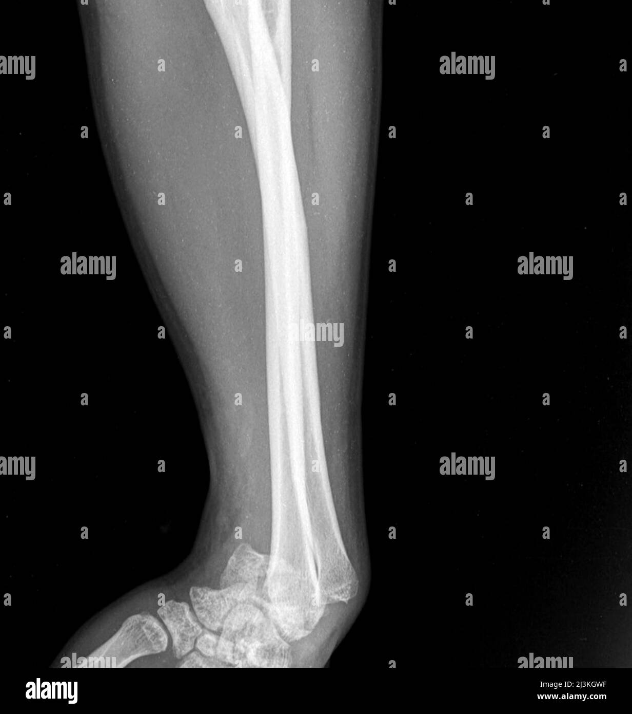 Verloschtes Handgelenk, Röntgen Stockfoto Verloschtes Handgelenk, Röntgen Stockfoto