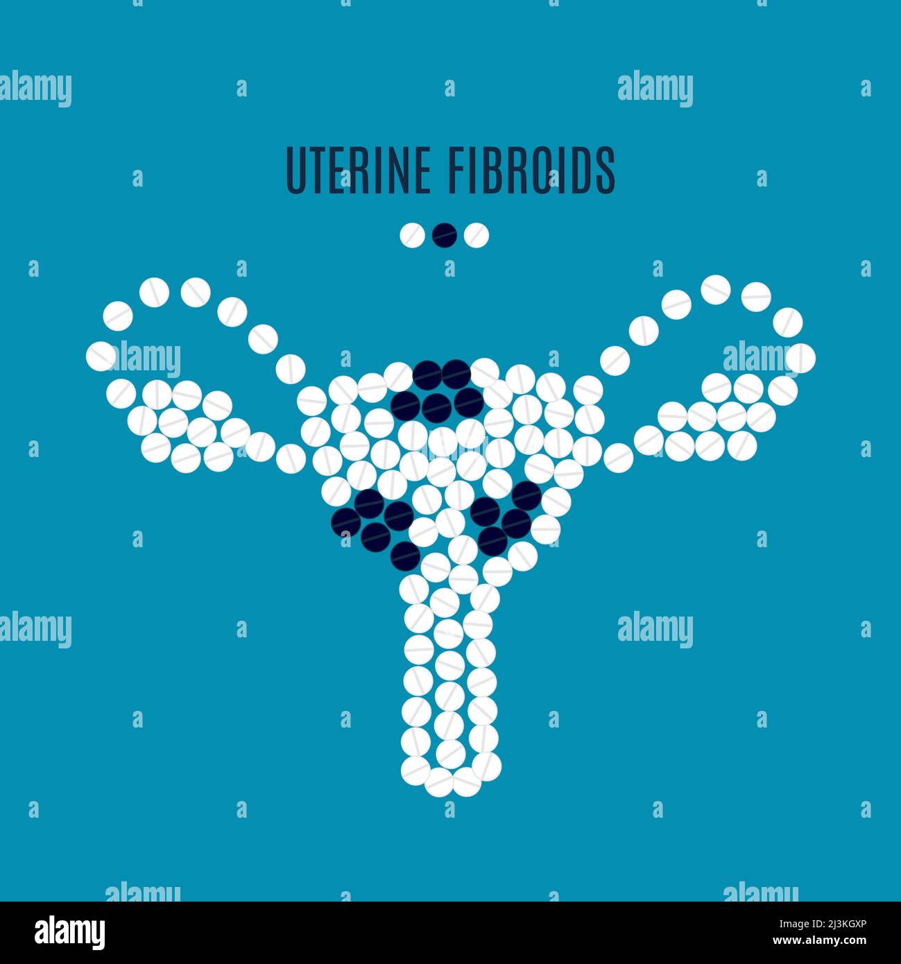 Uterusmyome, konzeptuelle Illustration Stockfoto