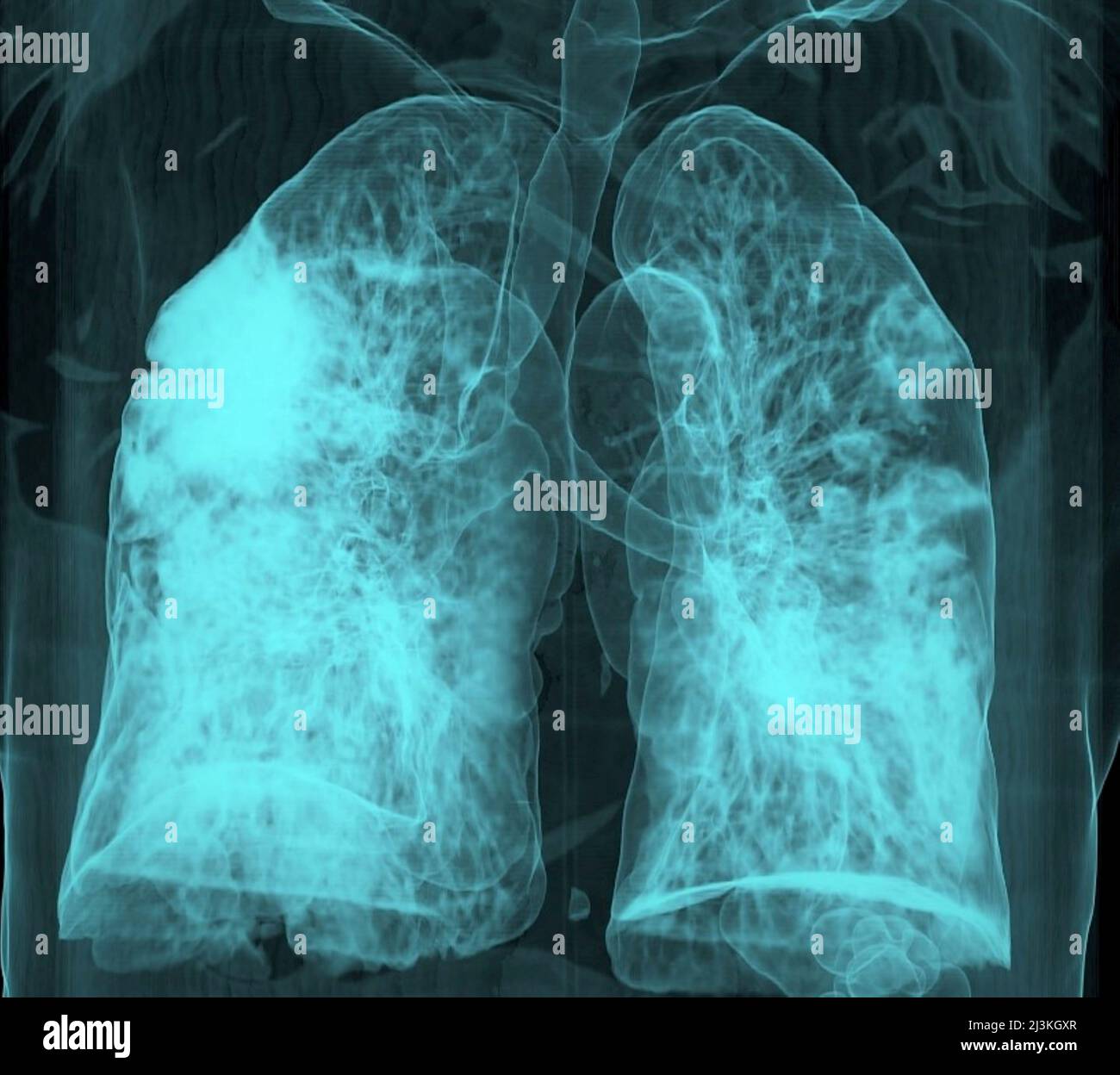 Covid-19 Pneumonie, 3D CT-Scan Stockfoto