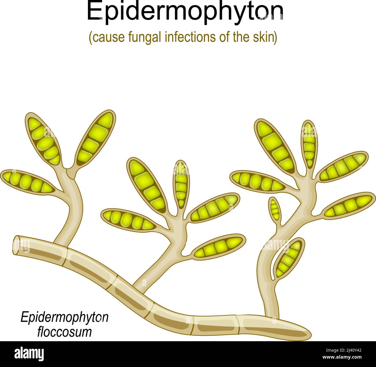 Epidermophyton floccosum. Pilzinfektionen der Haut. Vektorgrafik Stock Vektor