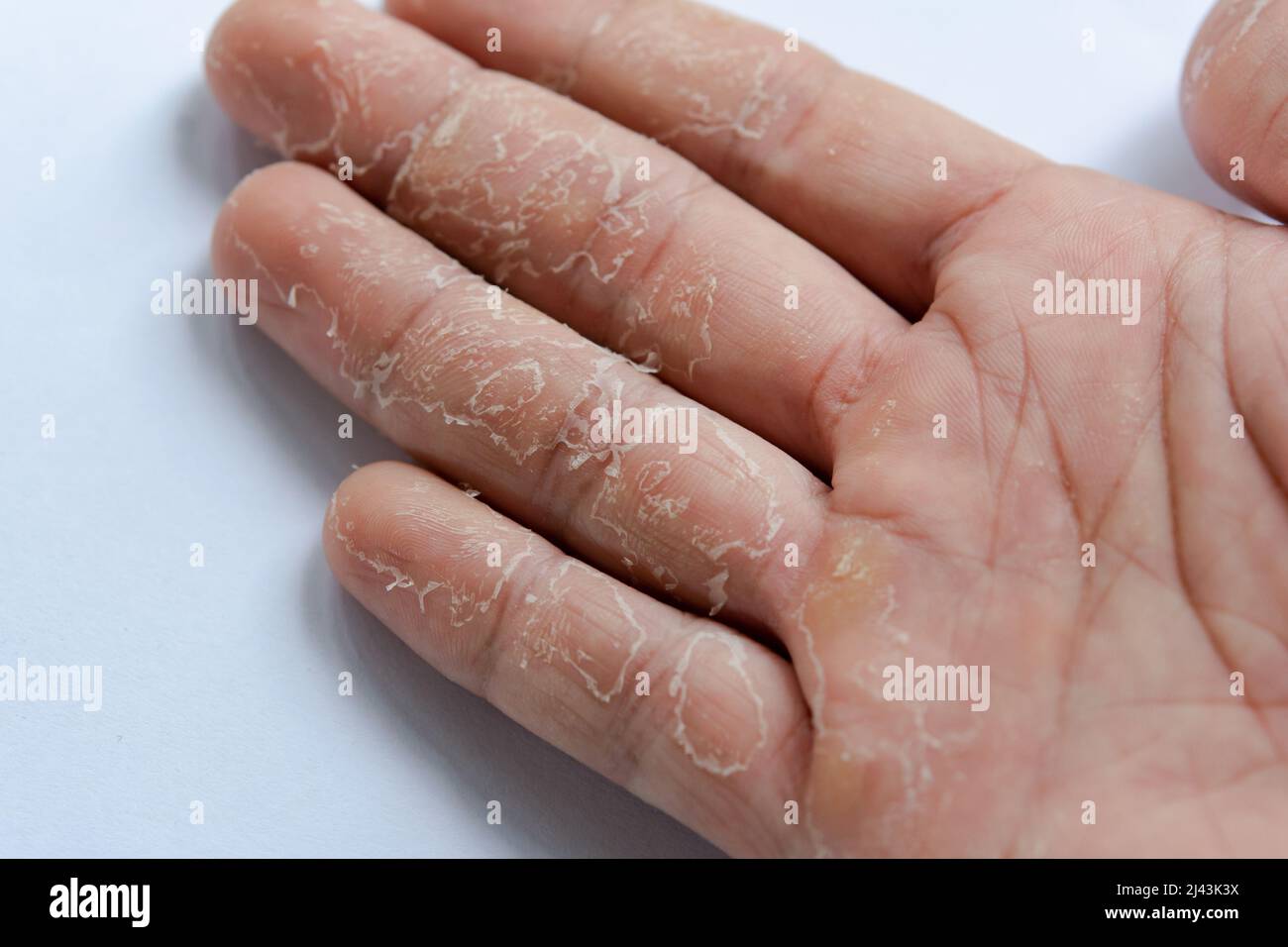 Haut an Hand und Fingern schälen. Desquamation Stockfotografie Alamy