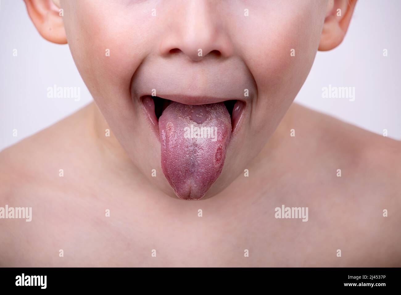 Dunkle Flecken Auf Der Zunge www.alamy.de