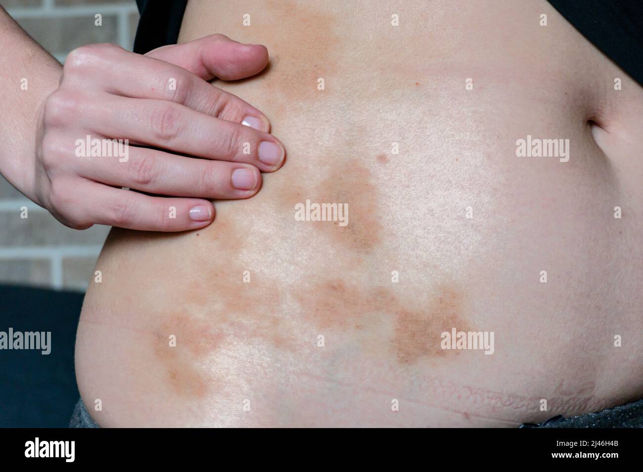 Rot-braune Flecken auf der Haut einer Frau in der Nähe des Abdomens. Stockfoto