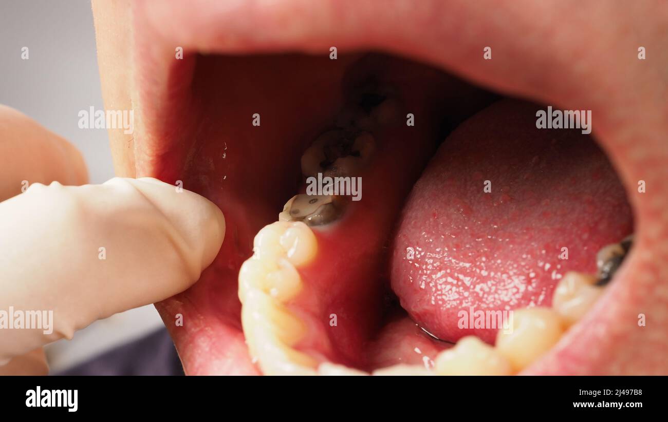 Verfallener Zahnwurzelkanal Behandlung. Zahn oder Zähne Karies des unteren Molars. Restauration mit einer Kompositfüllung. Erwachsene Karies. Schlechte Zähne. Zahnarztvorbehandlung Stockfoto