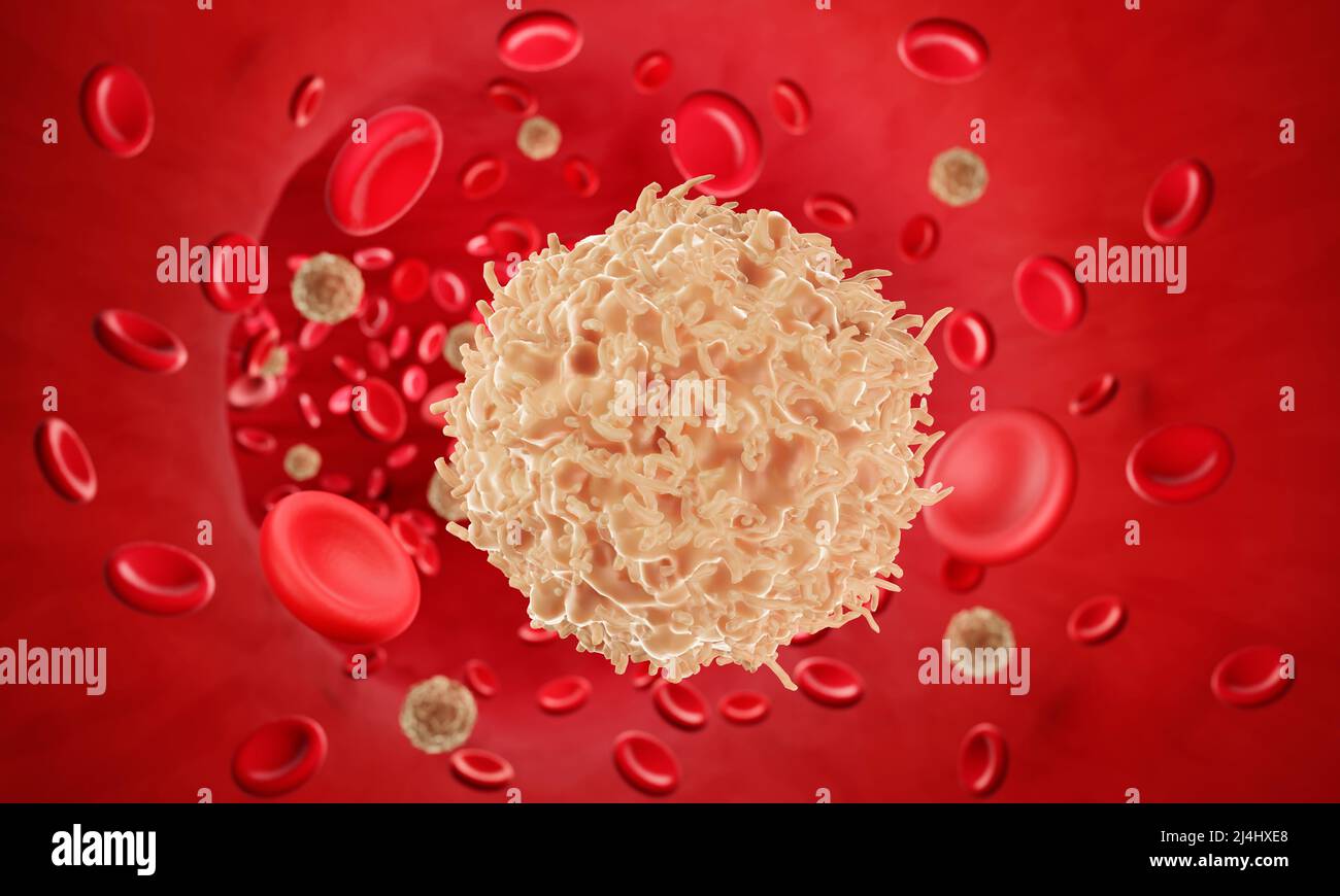 Die metastase Fotos und Bildmaterial in hoher Auflösung Alamy