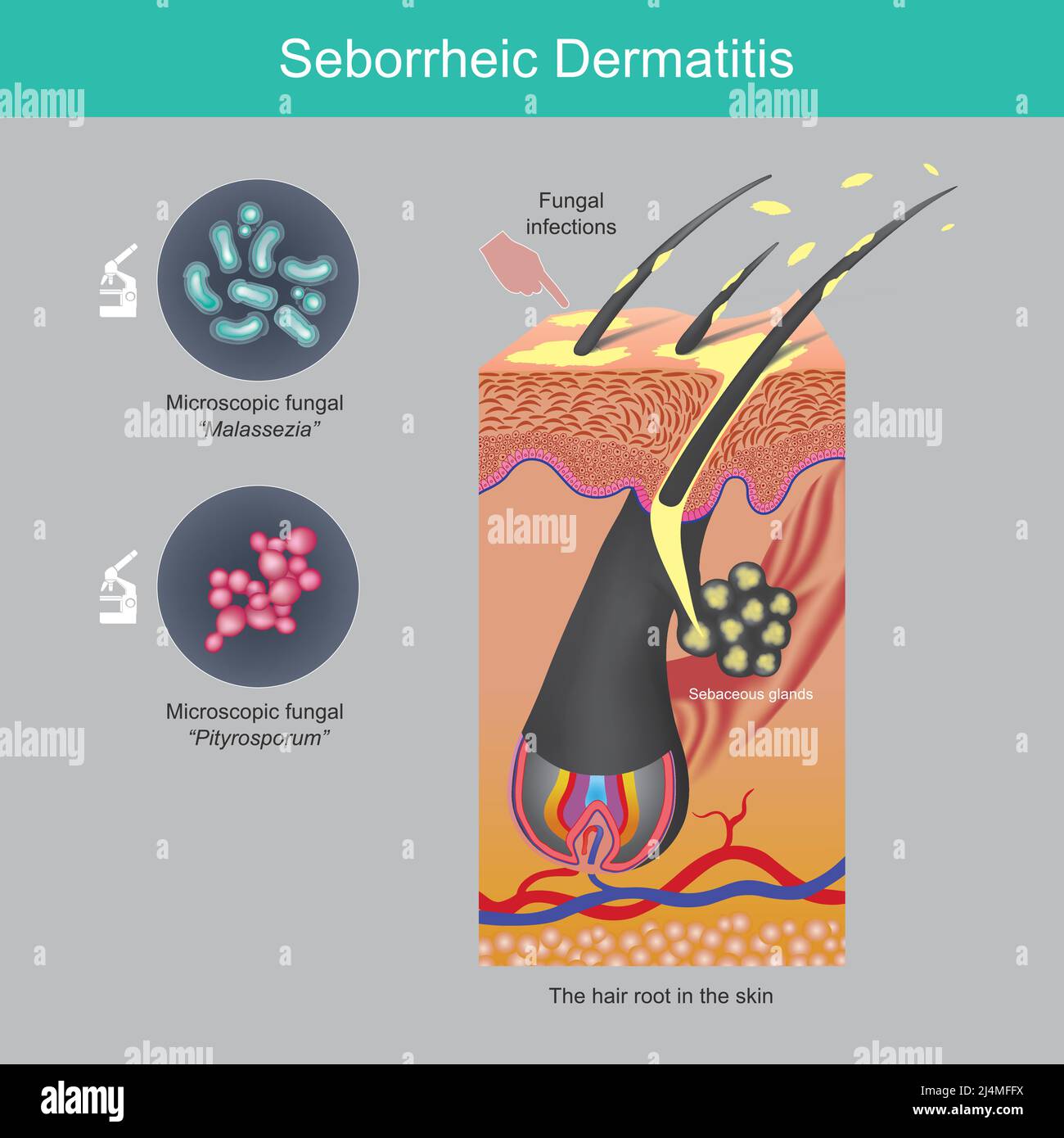 Seborrhoische Dermatitis. Kopfhautabfall der Blätter Problem durch Talgdrüsen in Haarwurzeln Haut und Pilze auf der Haut verursacht. Stock Vektor