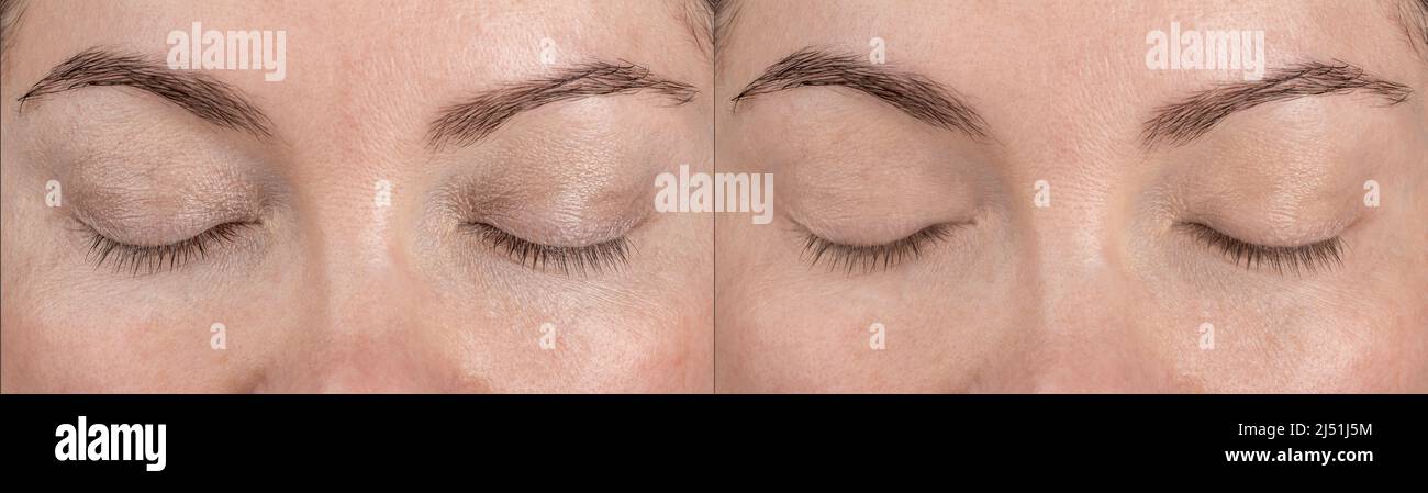 Haut um die Augen, Augenlider vor und nach der Anwendung von Pflegekosmetik oder kosmetischen Verfahren, Cremes, Seren, Masken. Teilweise Gesicht Frau mittleren Alters. P Stockfoto