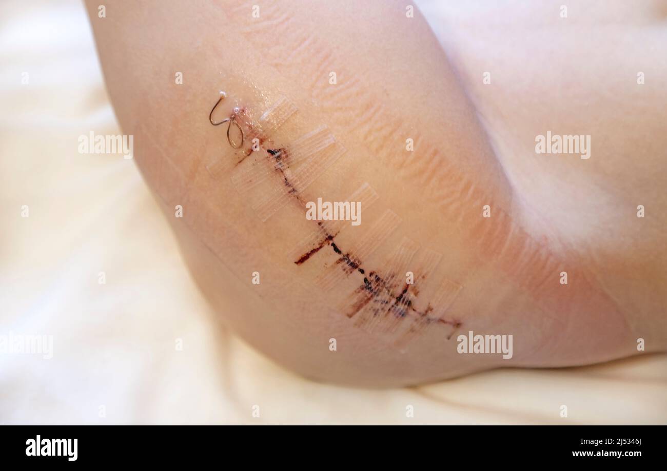 Narbe aus einer Operation am Bein eines Kindes mit schwarzer Faser. Hüftoperation. Stockfoto