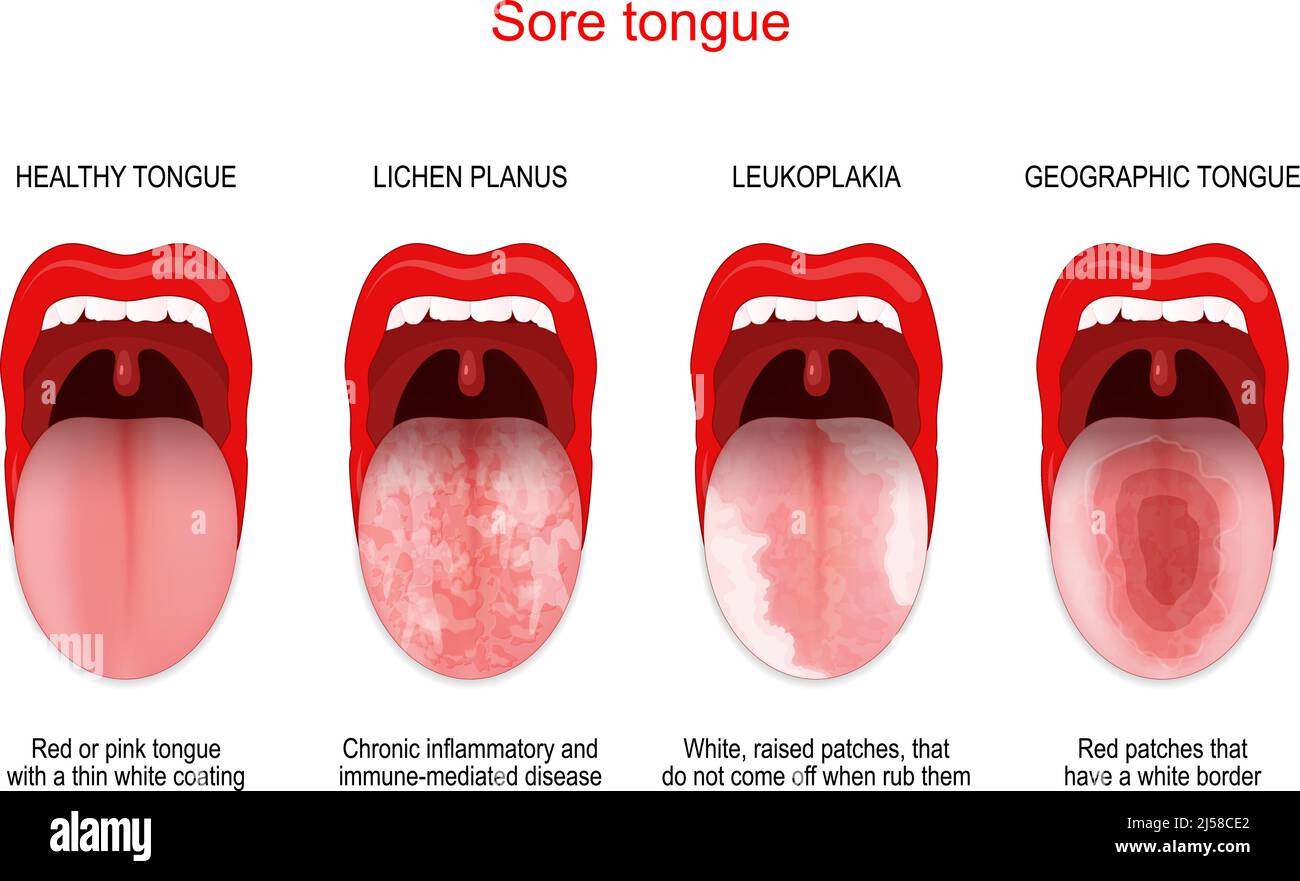 Wunde oder weiße Zunge. Vergleich von gesunder Zunge und oraler Erkrankung: Flechten planus, Leukoplakie, Geografische Zunge. Vektorposter für den medizinischen Gebrauch Stock Vektor