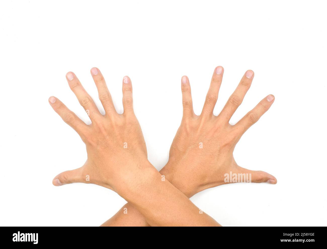 Spastische Hand. Spastizität der Handmuskulatur. Konzept der Gesundheit der Hand- und Fingergelenke. Stockfoto