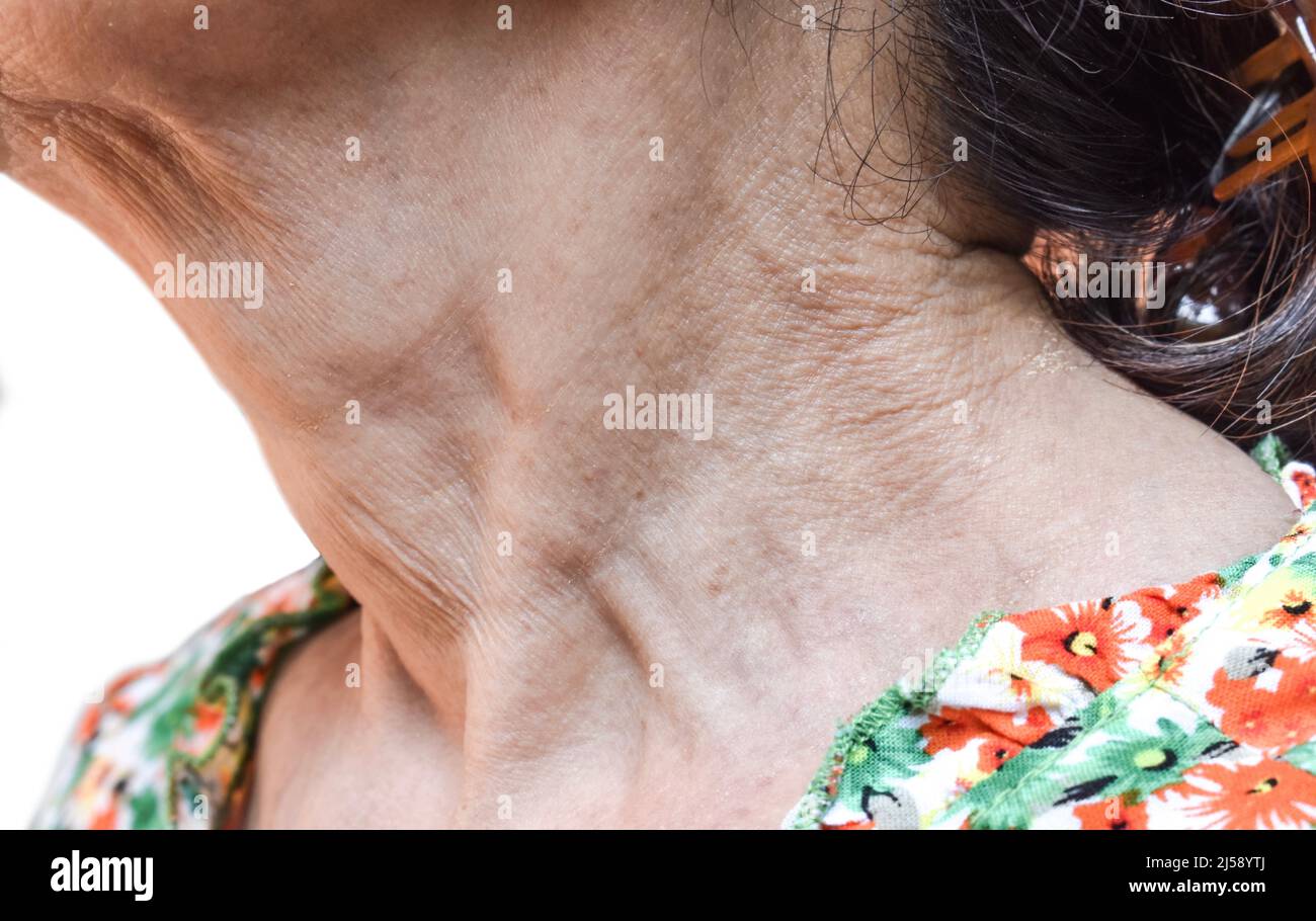Alternde Hautfalten oder Hautfalten oder Falten südostasiatischer, chinesischer alter Frau. Stockfoto