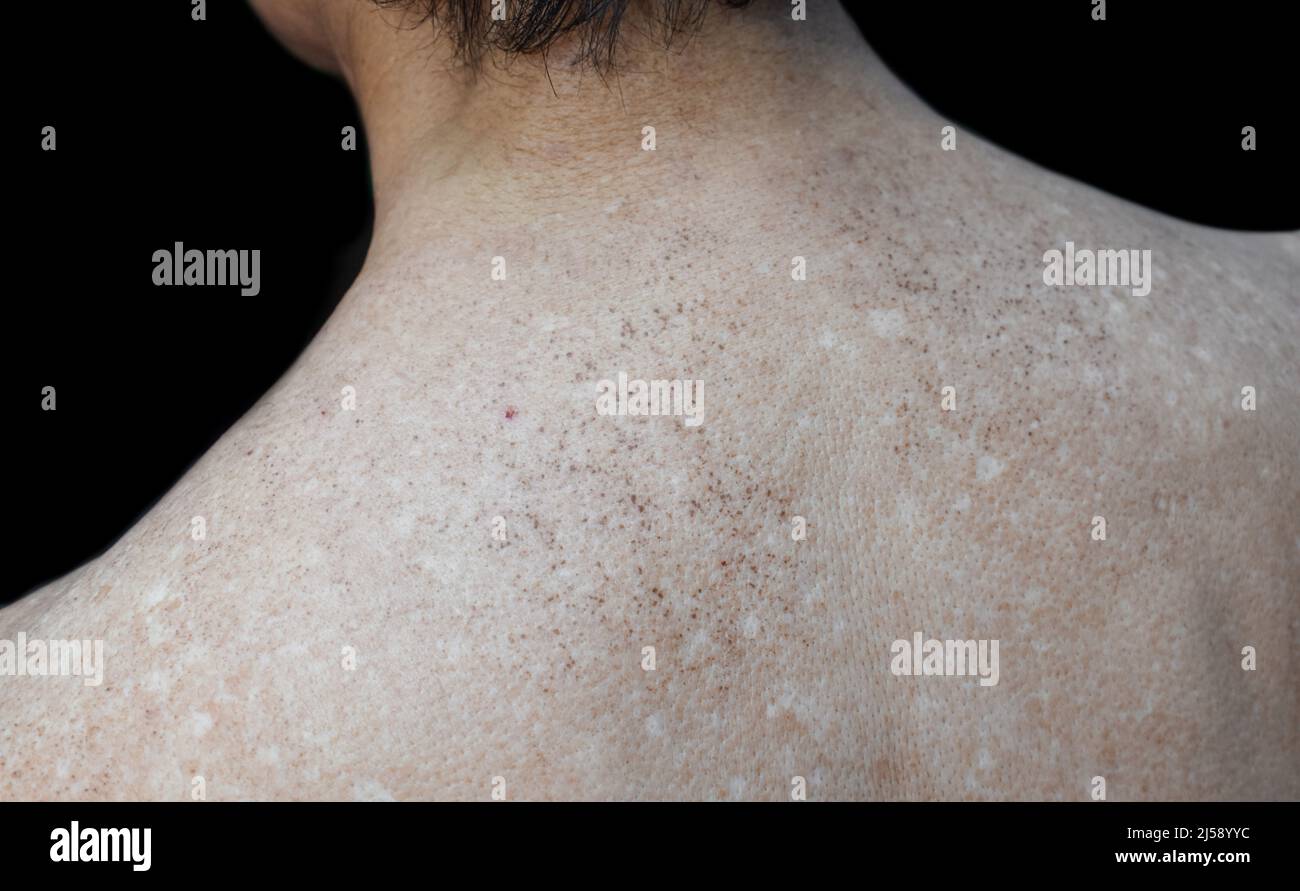 Weiße Punkte Auf Dem Rücken www.alamy.de