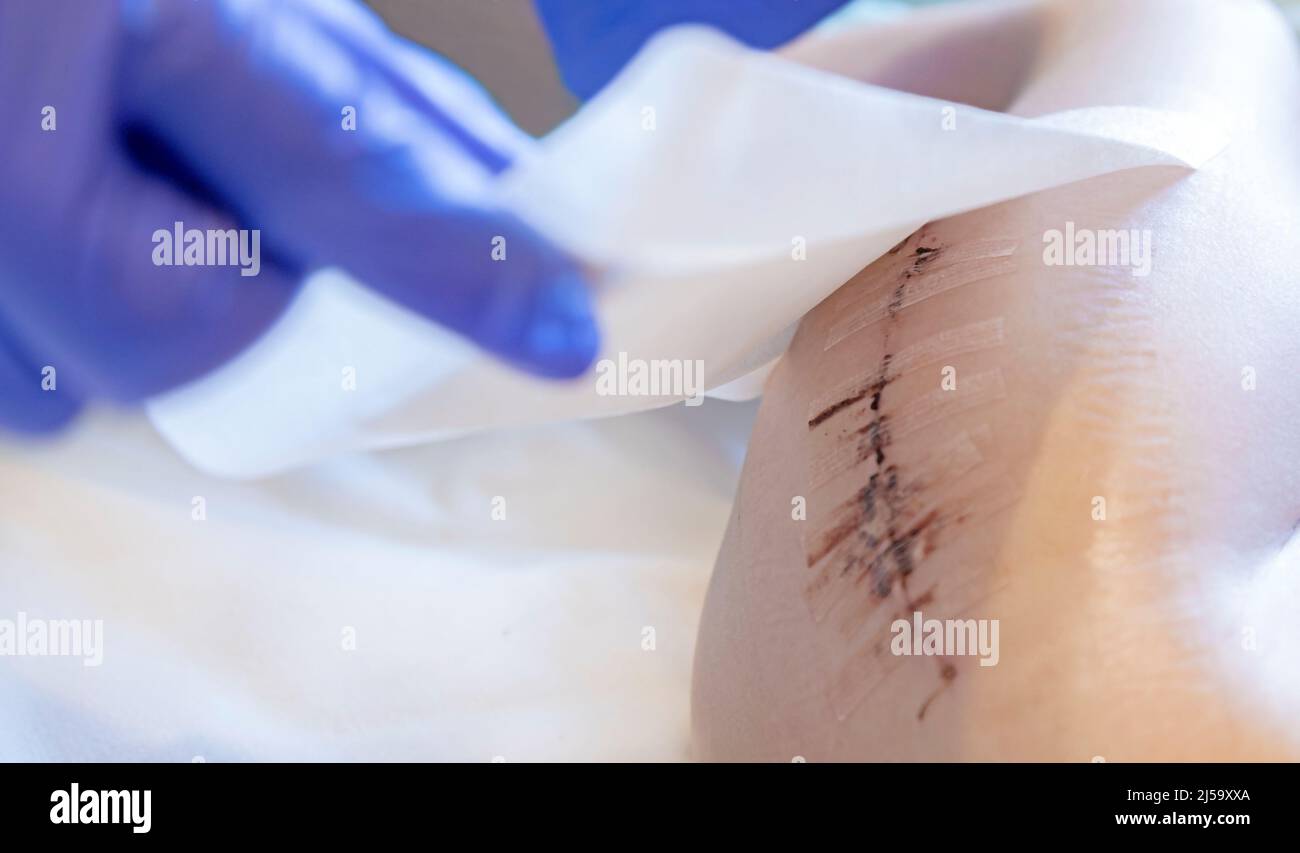 Der Arzt trägt nach einer Operation am Bein des Kindes einen Pflaster auf die Narbe auf. Antibakterielles Pflaster. Stockfoto