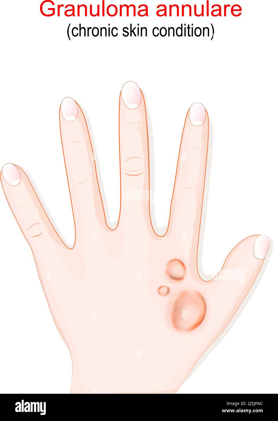 Granulom annulare. Chronische Hauterkrankung. Hand mit rötlichen Beulen auf der Haut in einem Kreis oder Ring angeordnet. vektor-Illustration Stock Vektor