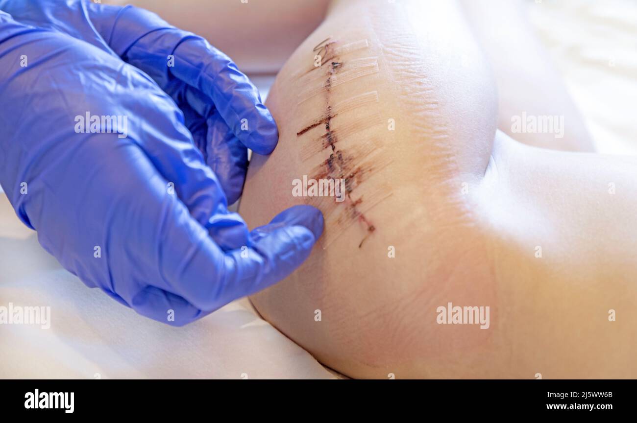 Hüftchirurgie, Kinderchirurgie, Chirurgen Hände untersuchen die Wunde auf dem Bein des Kindes Stockfoto