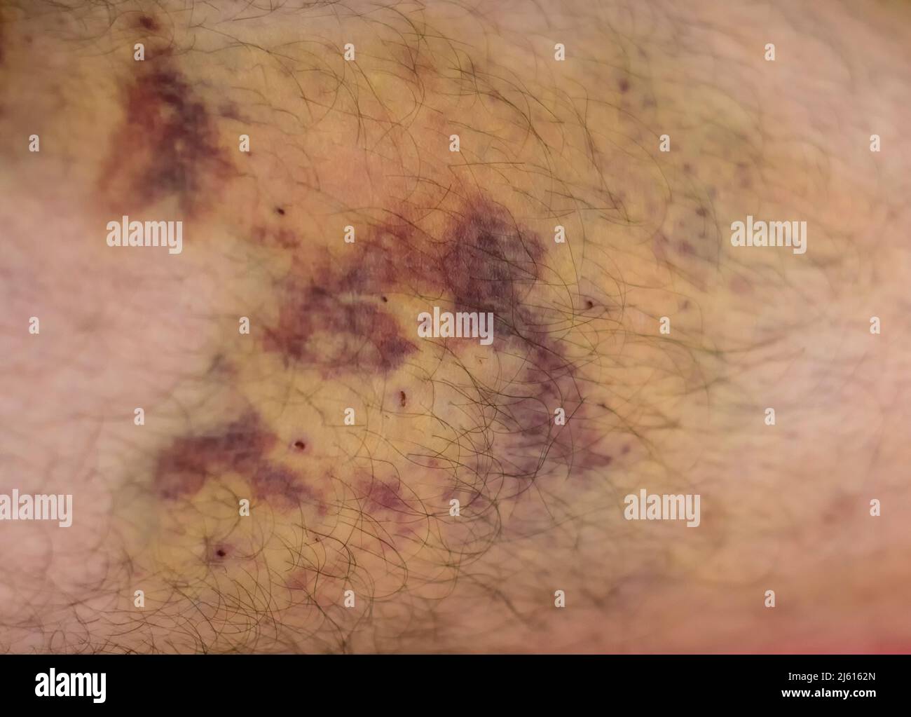 Großes Hämatom am Bein nach Injektionen für eine medizinische Operation. Stockfoto