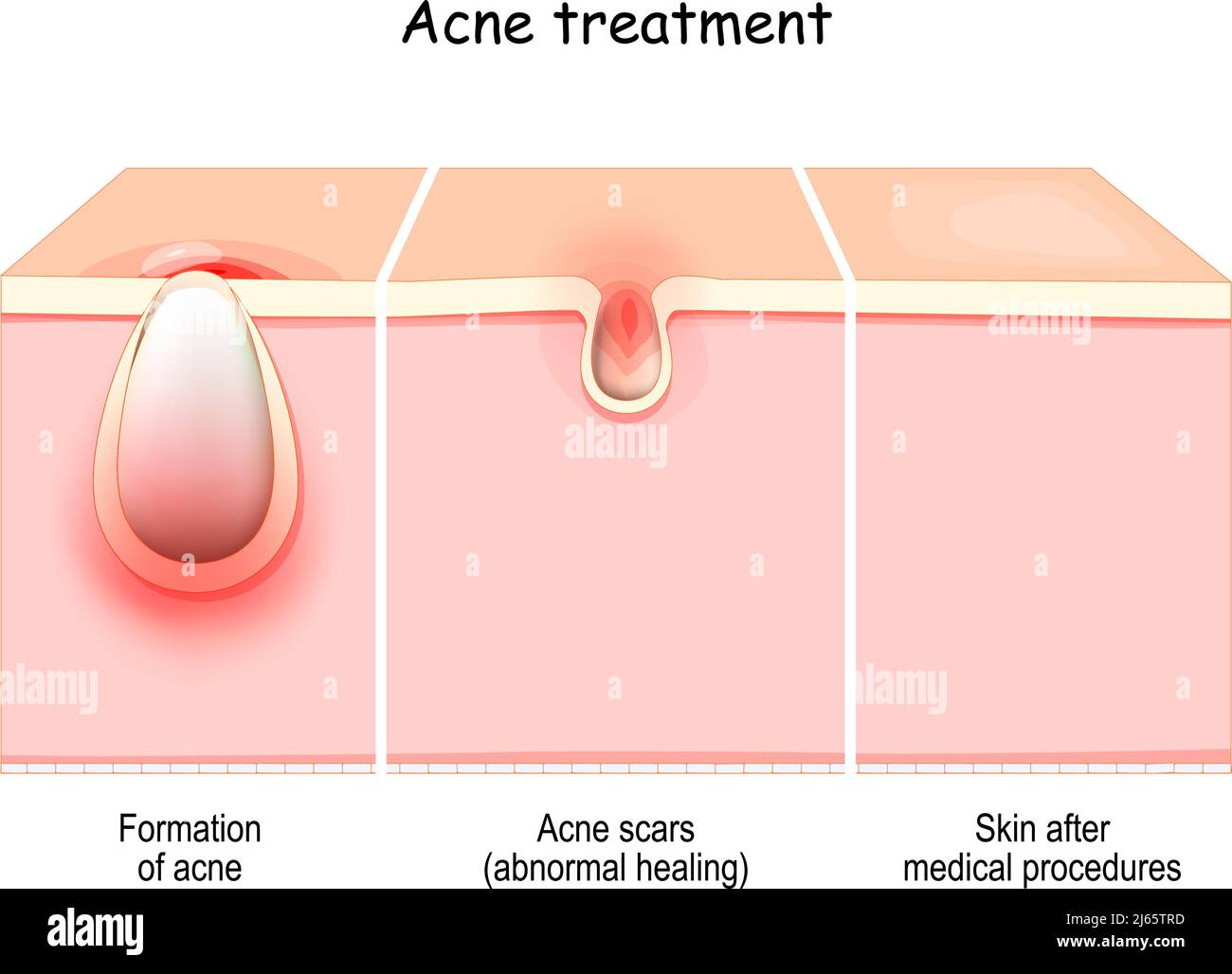 Akne-Behandlung. Querschnitt der Haut von der Bildung von Akne bis zu Narben oder abnorme Heilung. Gesunde Haut, Haut vor und nach dem medizinischen Eingriff Stock Vektor