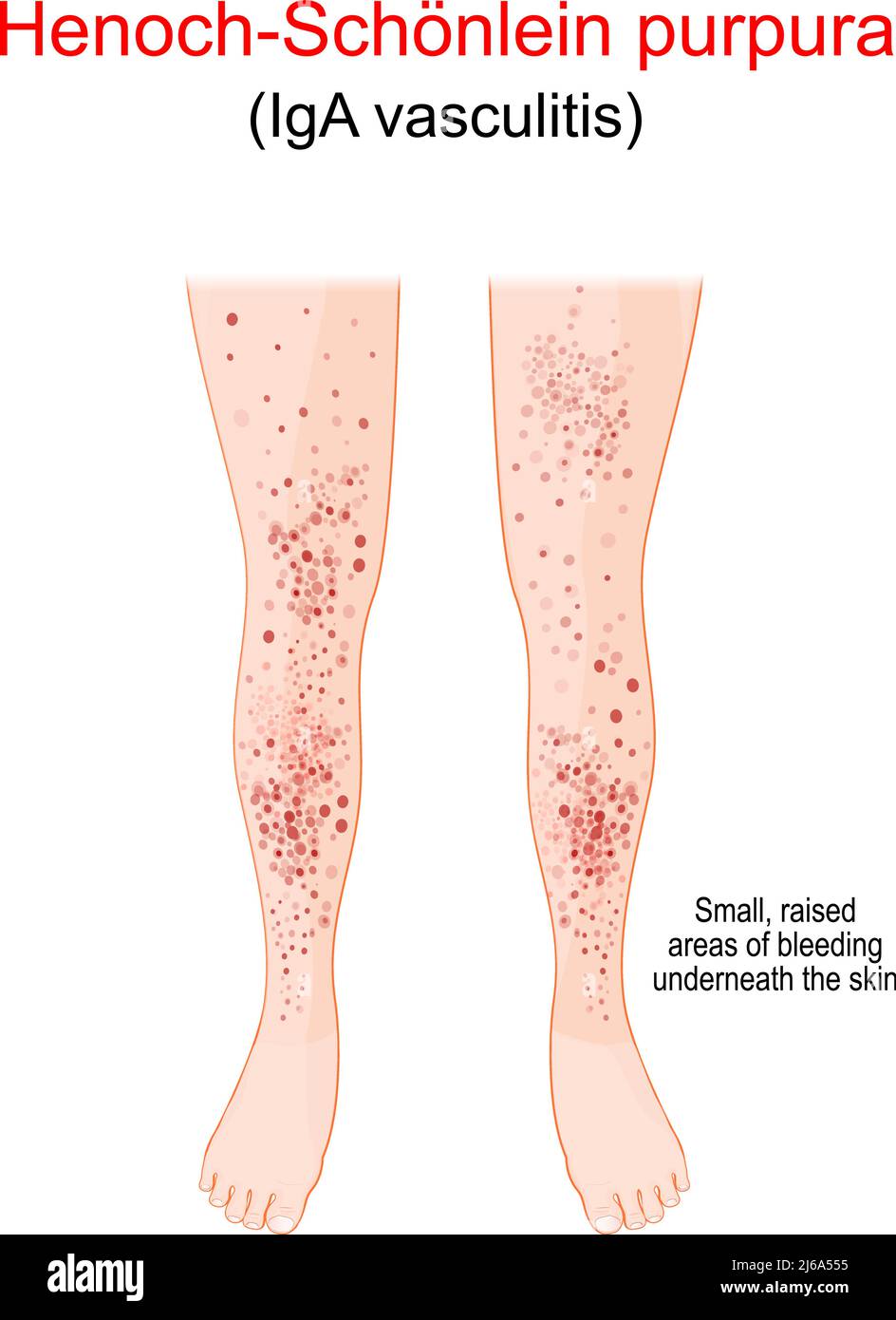 Henoch-Schönlein purpura. Fleckiger Ausschlag an den Beinen des Menschen. Die Flecken werden durch Blutungen unter der Haut, Gefäß- oder Gerinnungsstörungen verursacht Stock Vektor