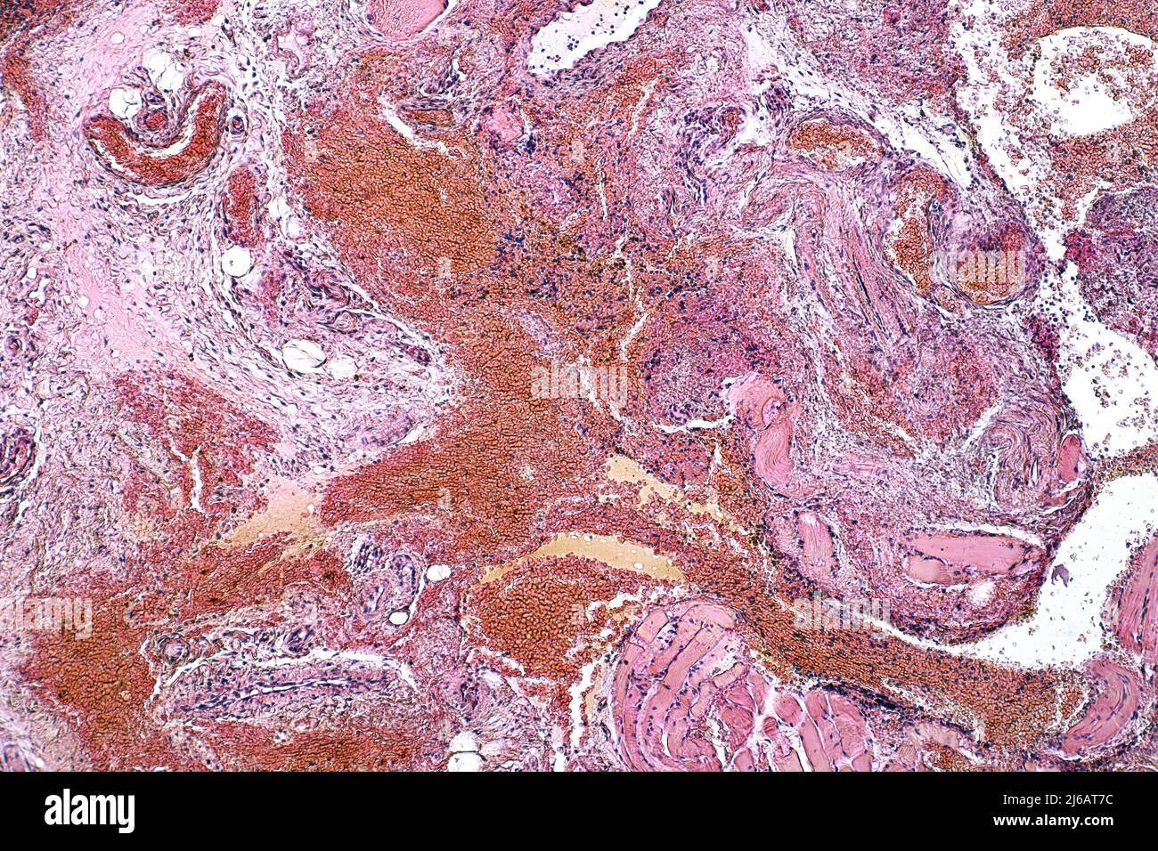 Tonsilitis, leichte Mikrographie Stockfoto