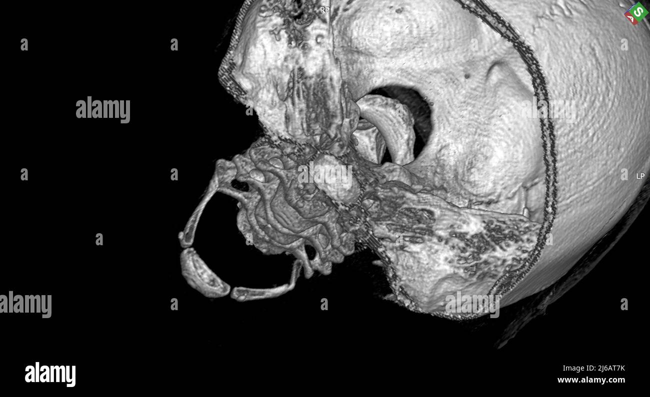 Gebrochener Hyoidknochen, 3D CT-Scan Stockfoto