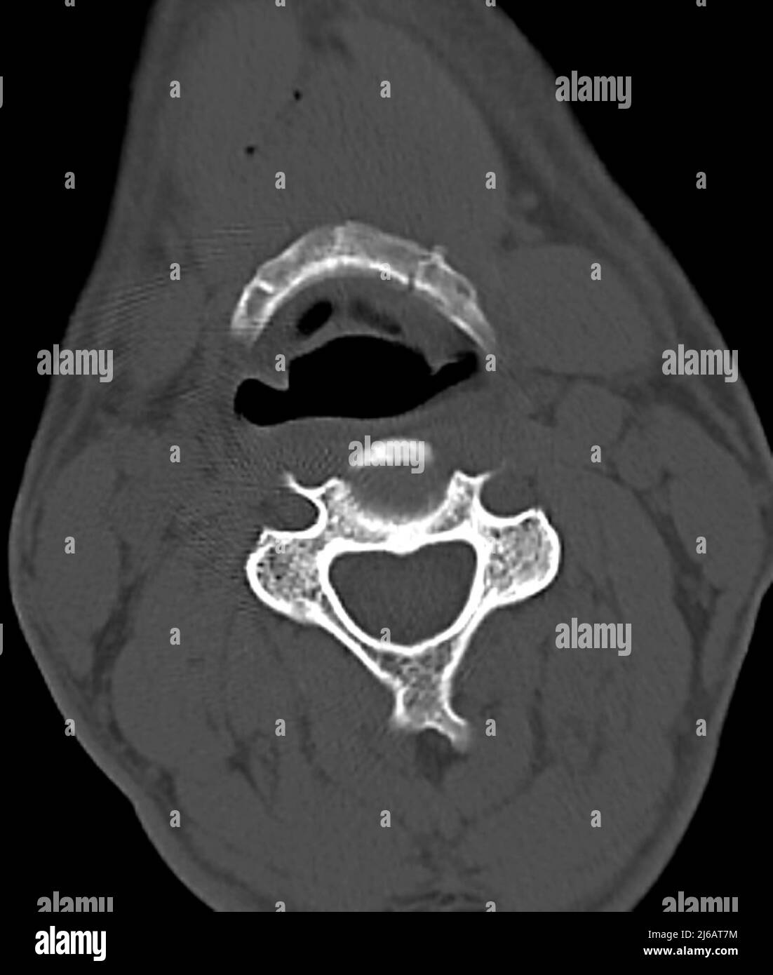 Gebrochener Hyoidknochen, CT-Scan Stockfoto