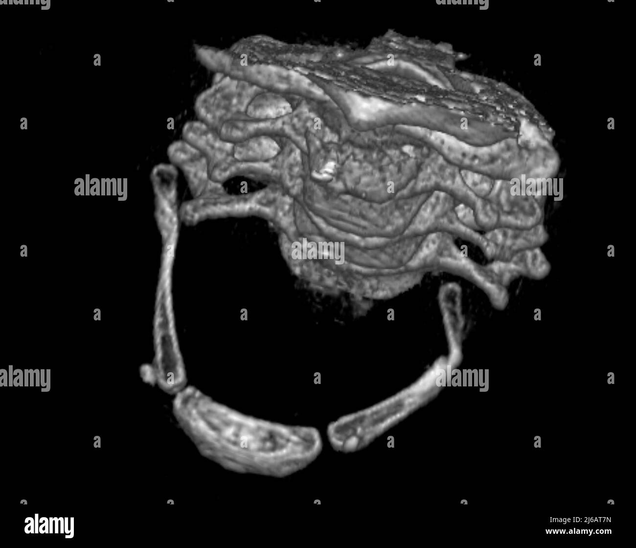 Gebrochener Hyoidknochen, 3D CT-Scan Stockfoto