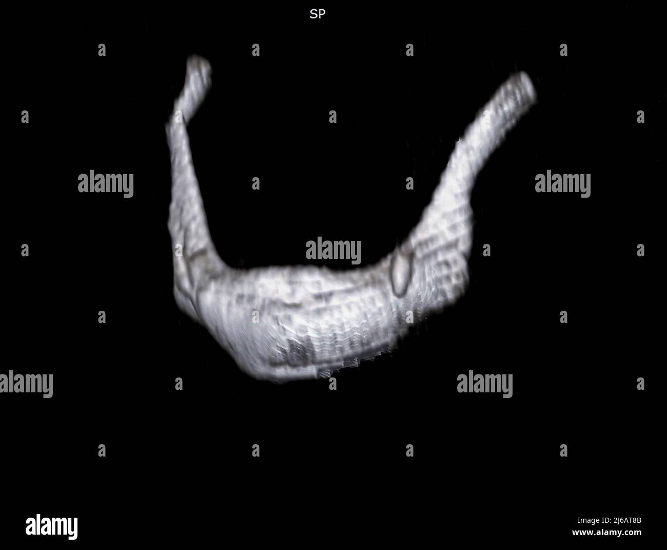 Gebrochener Hyoidknochen, 3D CT-Scan Stockfoto