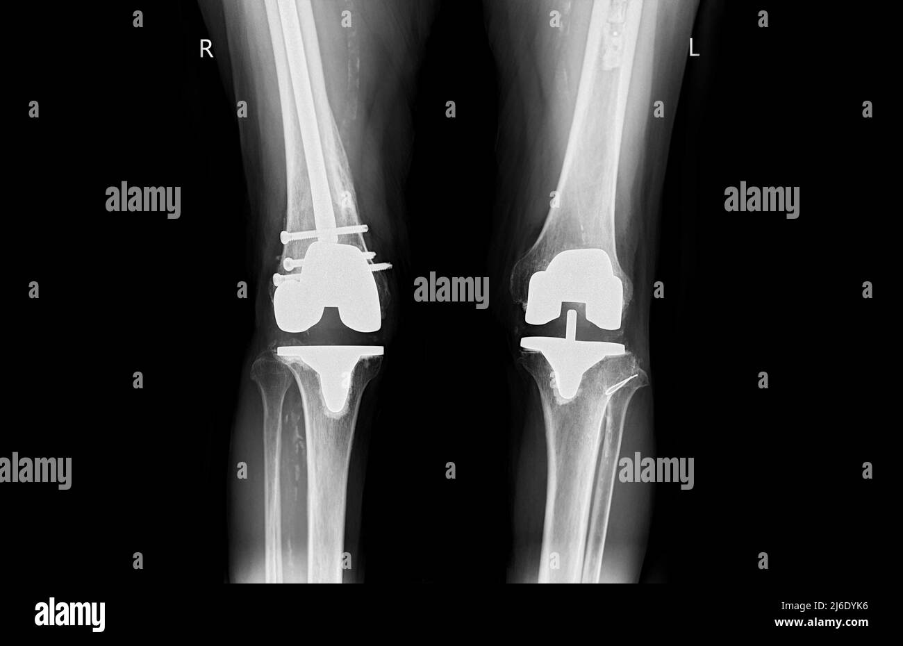 Filmen Sie die AP-Ansicht des Röntgenknies eines Arthrose-Kniepatienten und eines künstlichen Gelenks mit Knieersatz. Stockfoto