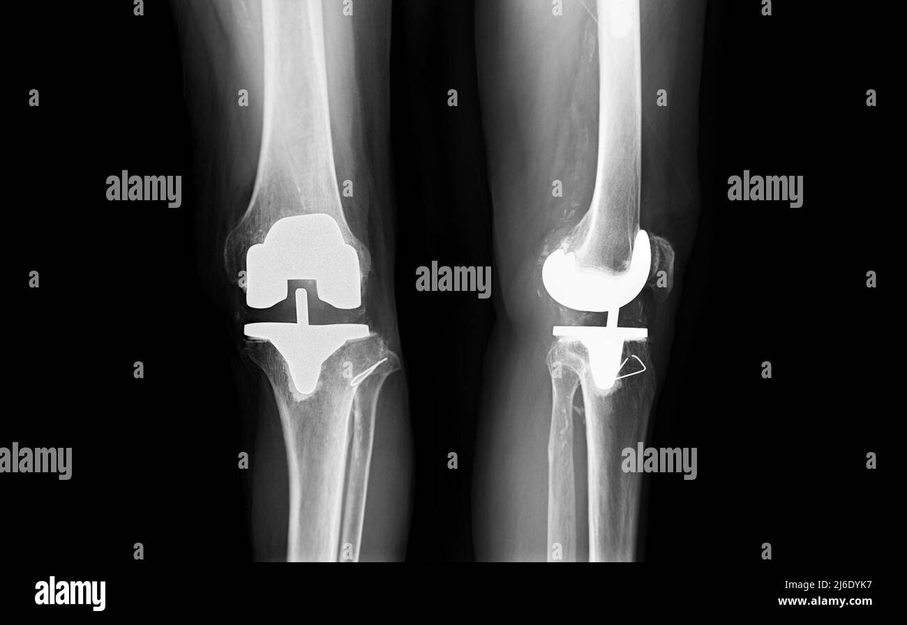 Filmen Sie das linke Knie AP und die laterale Ansicht des Arthrose-Kniepatienten und des künstlichen Gelenks mit Knieersatz. Stockfoto