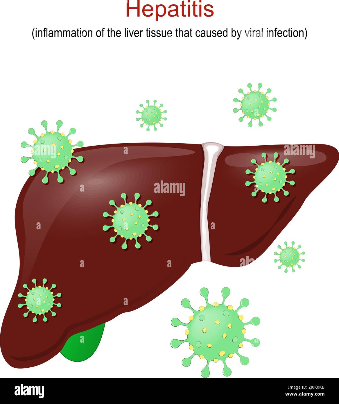 Hepatitis. Entzündung des Lebergewebes, die durch eine Virusinfektion verursacht wird. Leber des Menschen mit Virionen von Viren Hepatitis. Vektorgrafik Stock Vektor