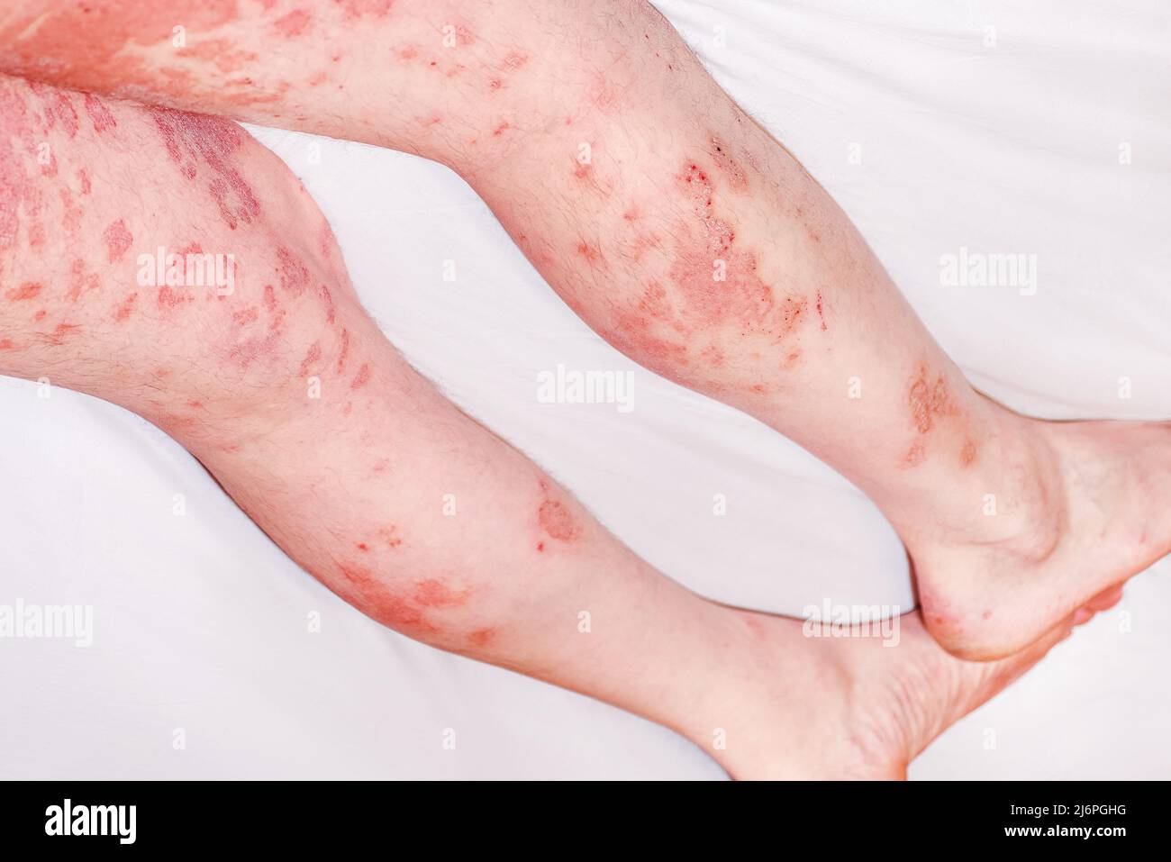 Akute Psoriasis, schwere Rötung der Haut, eine Autoimmunerkrankung, unheilbare dermatologische